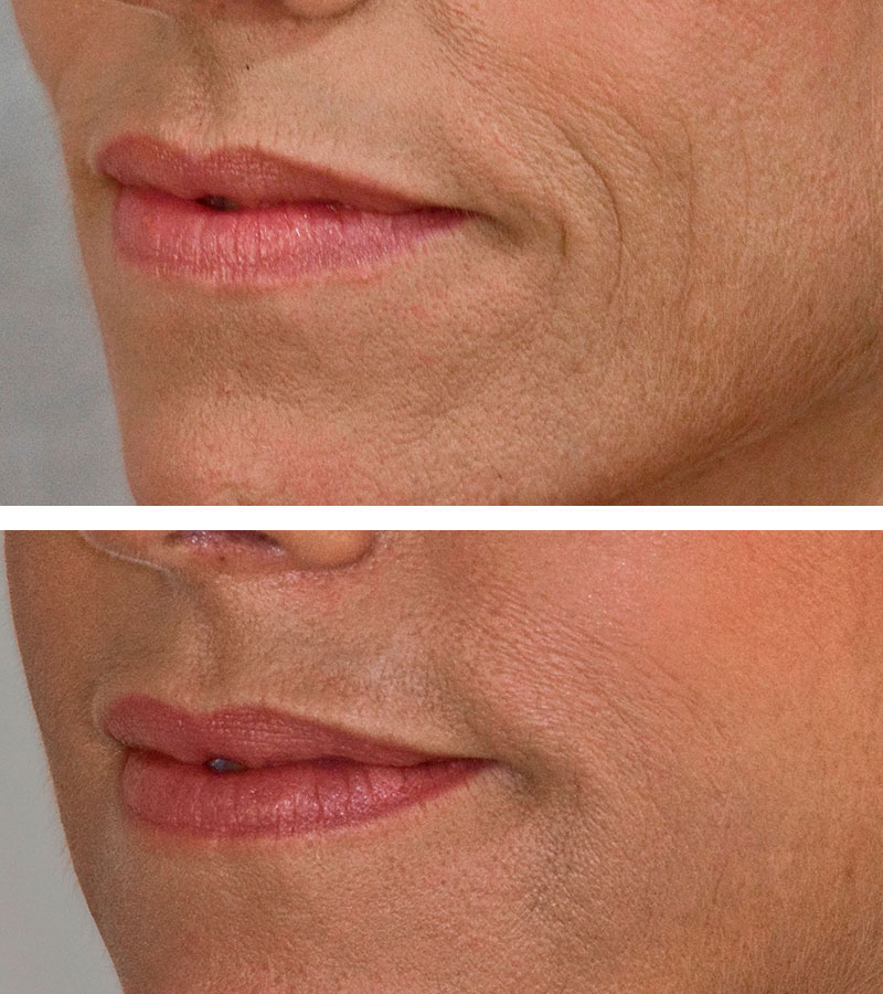 Graceful Healing - Dermal Fillers